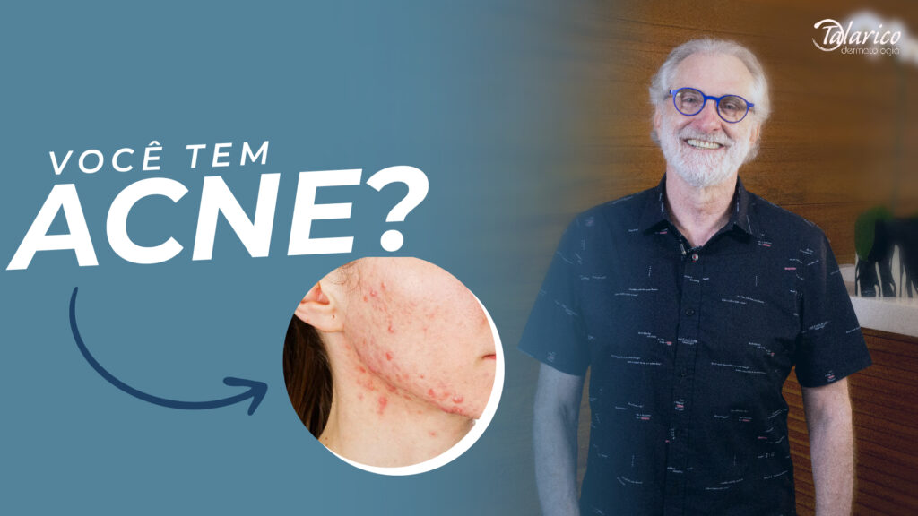 Saiba mais sobre a acne da mulher adulta